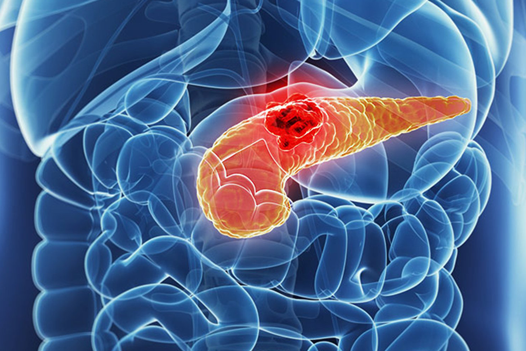 Pancreatic Cancer Surgery